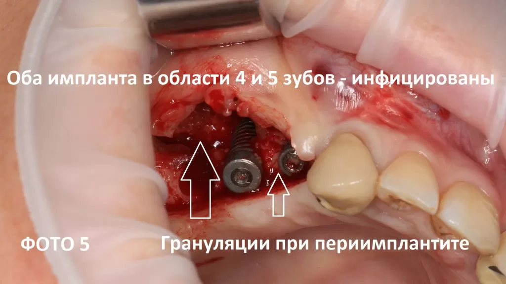 Оба импланта Ankylos инфицированы и с грануляциями